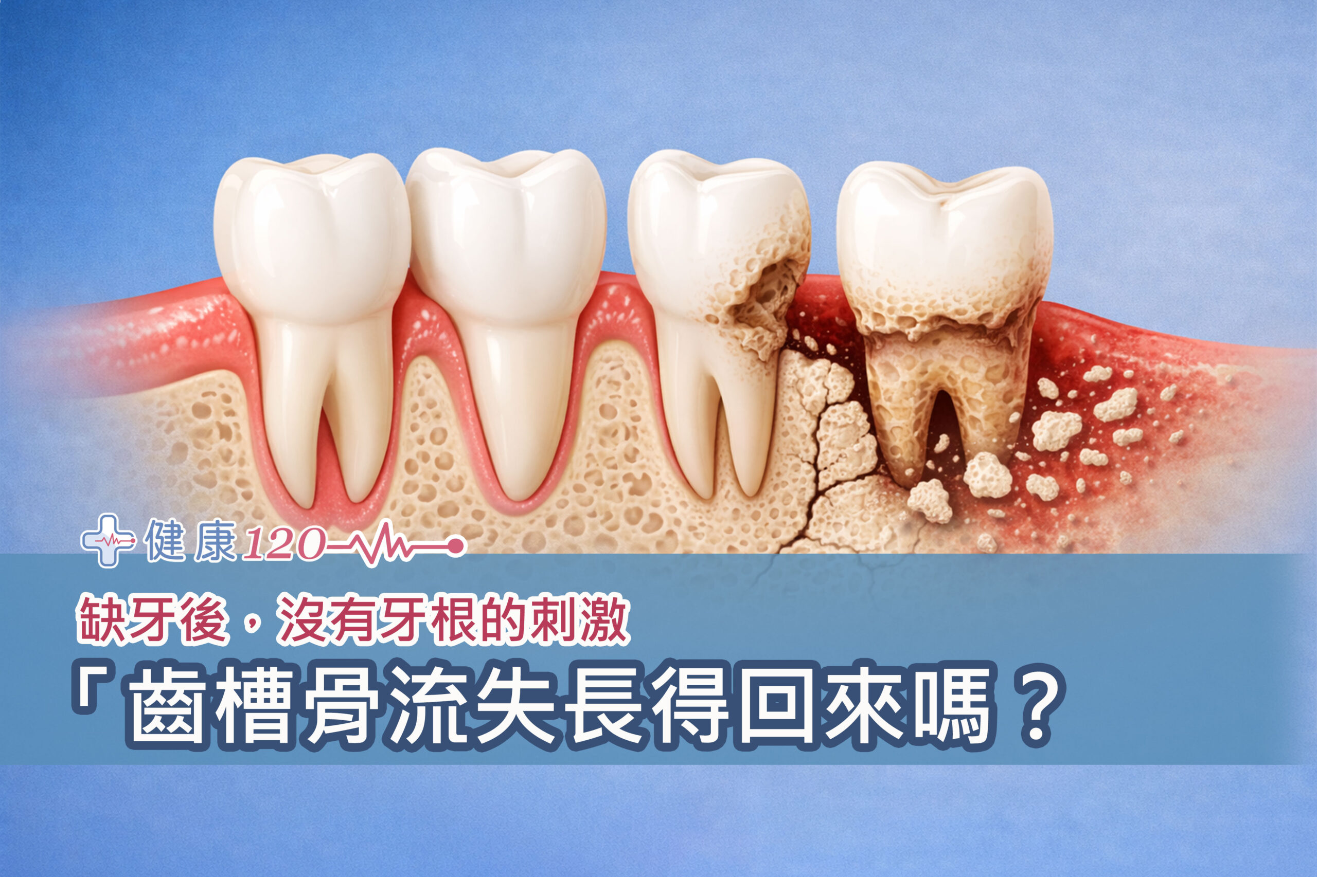 缺牙後，沒有牙根的刺激，齒槽骨流失長得回來嗎？