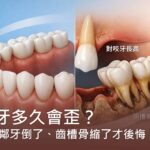 缺牙多久會歪？別等鄰牙倒了、齒槽骨縮了才後悔！