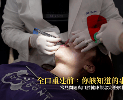 多顆缺牙怎麼辦？全口重建前你一定要知道的 4 件事