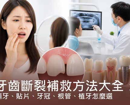 牙齒斷裂補救方法大全：補牙、貼片、牙冠、根管、植牙怎麼選